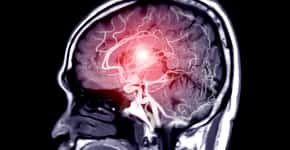 Sintoma frequente pode indicar aneurisma cerebral; saiba como identificar