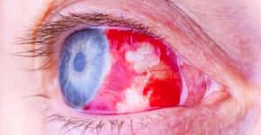 Vírus mortal que faz os olhos sangrarem é detectado na Espanha
