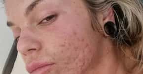 Mulher diz ter curado acne após abandonar lanche que comia 6 vezes ao dia