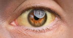 Olhos amarelados fazem mulher descobrir câncer terminal