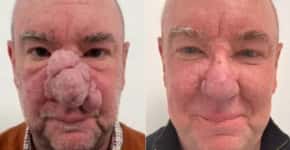 Homem reconstrói o nariz após rinofima; entenda a doença