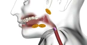 Entenda o que é câncer das glândulas salivares e como evitar