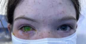 Austrália alerta para doença que muda cor do olho e causa dor intensa