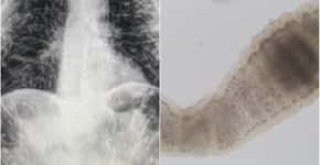 Cisticercose: causas e sintomas de larvas de tênia no corpo