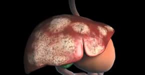 Câncer de fígado: os sintomas e as causas da doença