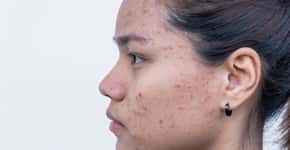 Estudo: remédio para pressão alta ajuda a suavizar acne adulta