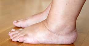Este sintoma no pé pode indicar um estágio grave de doença hepática