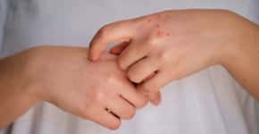 Sinais de câncer de pele para se observar nas mãos