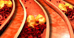 Conheça os sinais de colesterol alto que podem levar à amputação