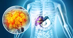 Estes sintomas de câncer de fígado podem ser confundidos com indigestão