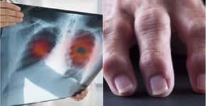 Sintomas inusitados de câncer de pulmão frequentemente ignorados