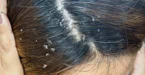 Sinais de câncer no couro cabeludo que podem ser confundidos com caspa