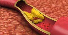 Colesterol alto: 5 formas naturais para acabar com o problema