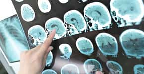 Alzheimer: exame mais acessível descobre sinais da doença mais cedo