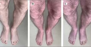 Descoberto raro sintoma de covid longa nas pernas