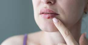 Sinais nos seus lábios podem indicar estas 3 doenças graves