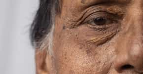 Como reconhecer Alzheimer observando os olhos