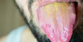 A cor da sua língua pode revelar várias doenças; veja exemplos