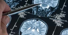 Autópsias revelam novas descobertas sobre o Alzheimer