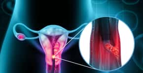 Sinais de alerta do câncer de colo de útero, o 3º mais comum em mulheres
