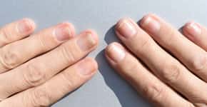 Alterações nas unhas que devem ser examinadas por um médico