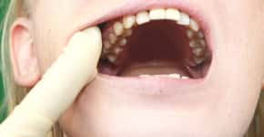 Crescem os casos de câncer de boca entre jovens; veja as causas