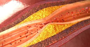 Três sinais de colesterol alto podem ser observados no corpo