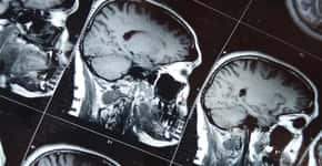 O que é a demência vascular e no que ela se difere do Alzheimer?