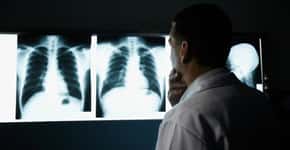 Medicamento evita progressão do câncer de pulmão em 60% dos casos