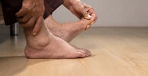 Colesterol alto pode dar sinais nos pés