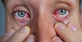 Síndrome do olho seco: quais os sintomas e como tratar a condição