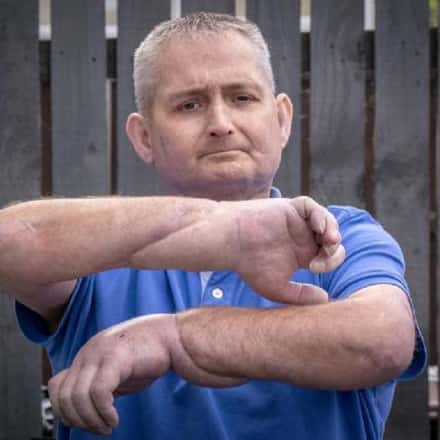 Homem recebe transplante duplo de mãos após doença rara