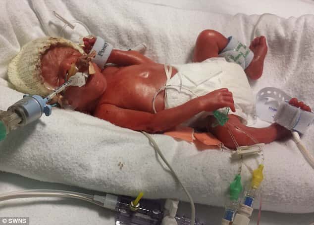 Bebê prematuro que tinha 50% de chance de sobreviver completa 2 anos