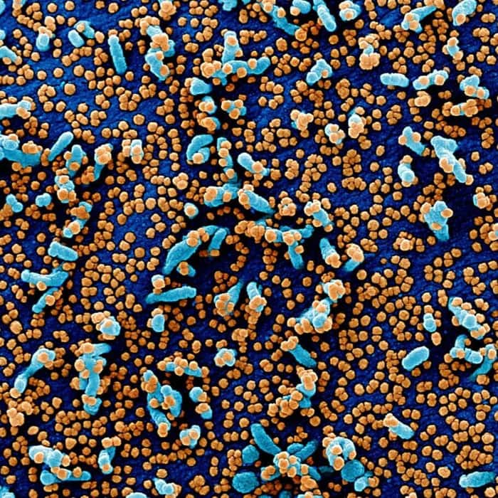 Imagem mostra coronavírus atacando células humanas em amostra de paciente contagiado 