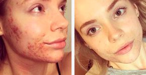 Jovem muda a alimentação e se livra de uma acne severa