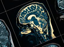 Featured side: Cientistas descobriram um gatilho oculto do Alzheimer e o desativaram