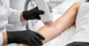 Quanto custa remover uma tatuagem pequena a laser em 2026?