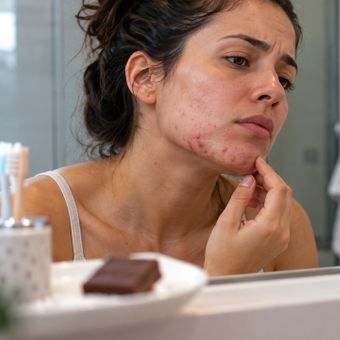 Featured mobile: A acne que surge depois dos 25 anos pode não ter relação direta com o chocolate, mas com alterações hormonais e resistência à insulina que favorecem a produção de sebo