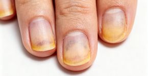 Método único recupera a cor natural das unhas amareladas em dias