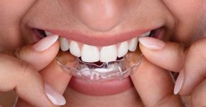Bruxismo: o que está por trás do ranger dentes? Saiba como reconhecer os sinais