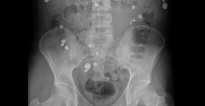 Foto: (Image courtesy of Lars Grimm, MD)