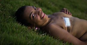 Câncer de mama: fotos mostram coragem e alegria de mulher após mastectomia