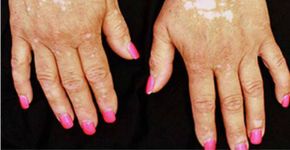 Cientistas revertem vitiligo em paciente com droga para artrite