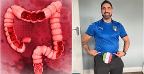 Foto: (reprodução/BowelCancer)