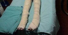Garota tem 80% do corpo queimado pelo companheiro no RS