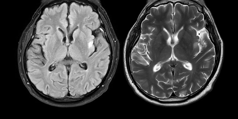 Featured main: Cientistas descobriram um novo gatilho para o Alzheimer e um medicamento que o inibe