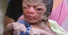 Bebê nasce com doença rara e lembra caso de Benjamin Button