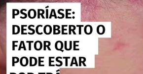 Psoríase: descoberto o fator que pode estar por trás da doença