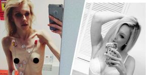 Jovem que chegou a pesar 35 kg faz alerta sobre a anorexia