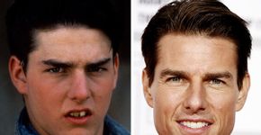 Famosos e anônimos mudaram muito após aparelhos dentários